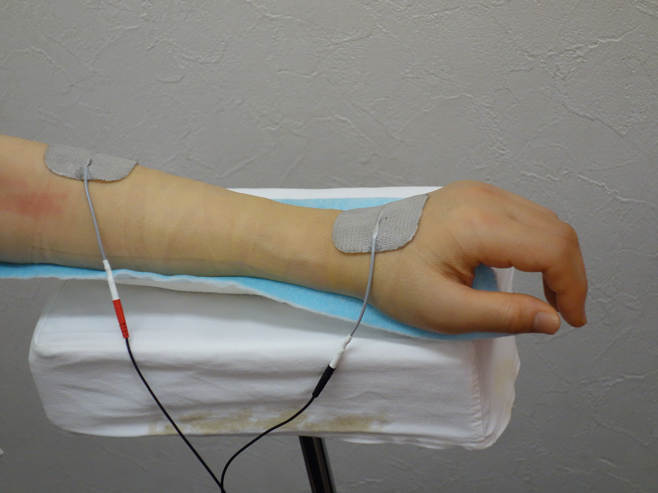 交通事故で手を骨折した患者さんの電気治療の写真