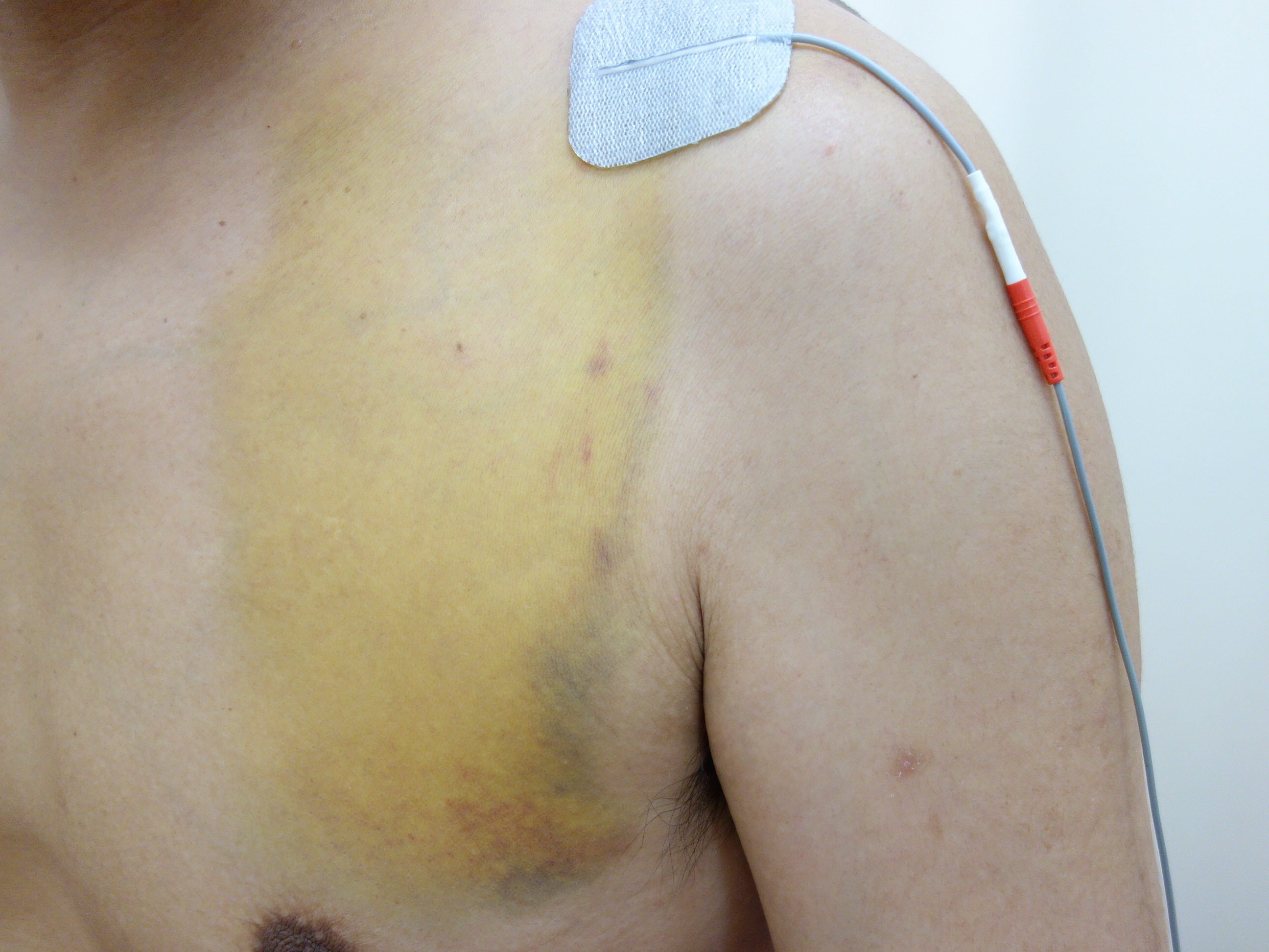 バイク事故で肩を打撲した男性の電気治療の写真